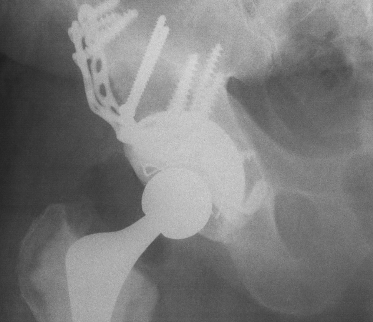 Revision Acetabulum Bulk Structural Allograft + Cage